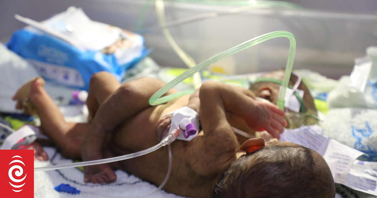 'We're running out of time': PNG parents make desperate global plea to save conjoined twins