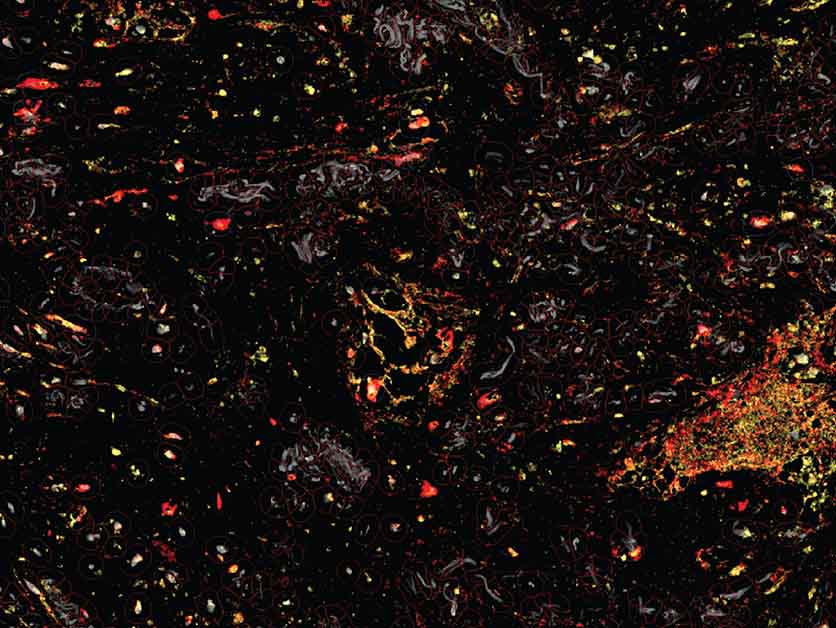 Turning the Tumor’s Shield into a Sword - Life Sciences | Weizmann Wonder Wander