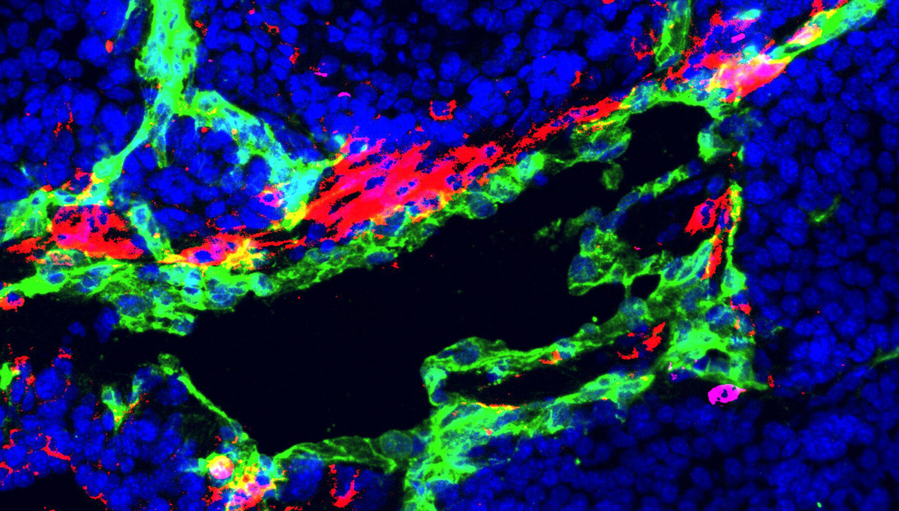 Scientists discover a drug to stop cancers resisting chemotherapy - Cancer Research UK
