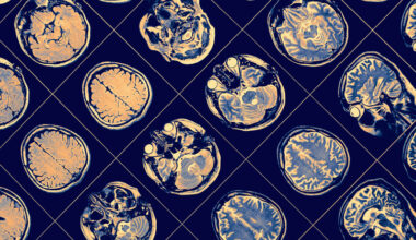 Study Finds Uneven Burden of Brain and Nervous System Cancers in the U.S. 