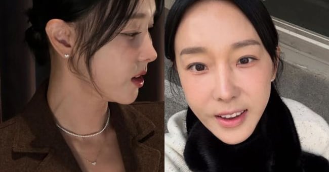 Lee Ji-hye Shares Post-Philtrum Reduction Life, Joy - 조선일보