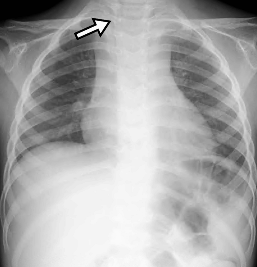 Incomplete Kawasaki Disease Mimicking Deep Neck Infection: A Case With Tracheal Deviation and Retropharyngeal Edema