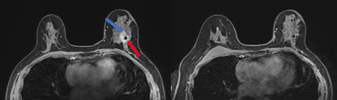 Two magnetic resonance imaging (MRI) scans