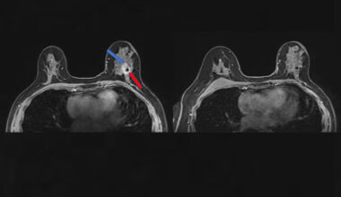 Single-dose radiation before surgery can eradicate breast cancer: Newsroom