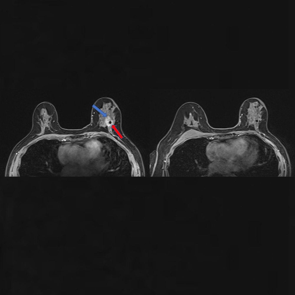 Single-dose radiation before surgery can eradicate breast cancer: Newsroom