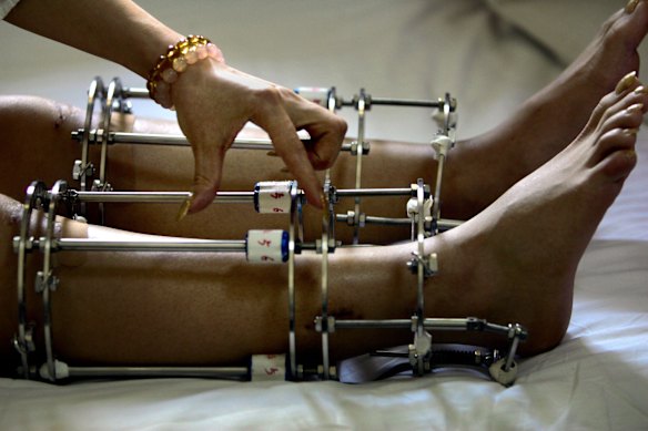 The Russian technique for stretching limbs seen here in a Chinese clinic. 