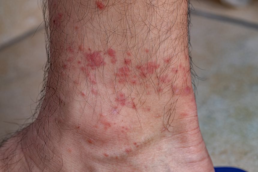 Avoiding tick bites is the best way to prevent alpha-gal syndrome.