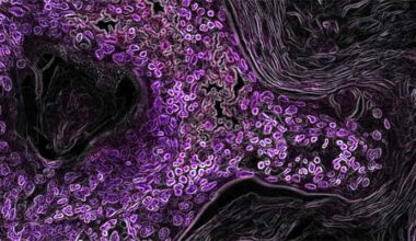 From Undruggable to Unstoppable: A New Cancer Cure Target Emerges