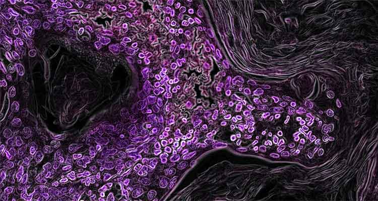 From Undruggable to Unstoppable: A New Cancer Cure Target Emerges