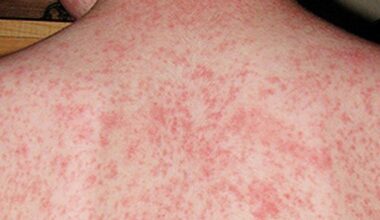 Canada loses measles-free status as vaccination rates fall