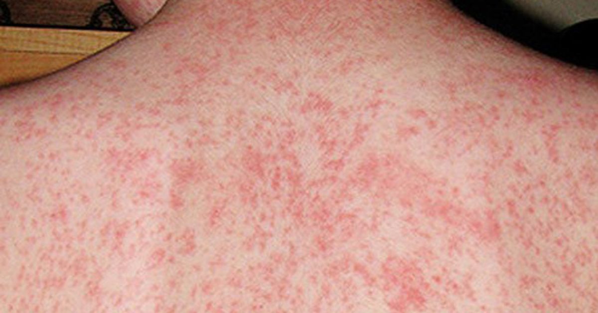 Canada loses measles-free status as vaccination rates fall