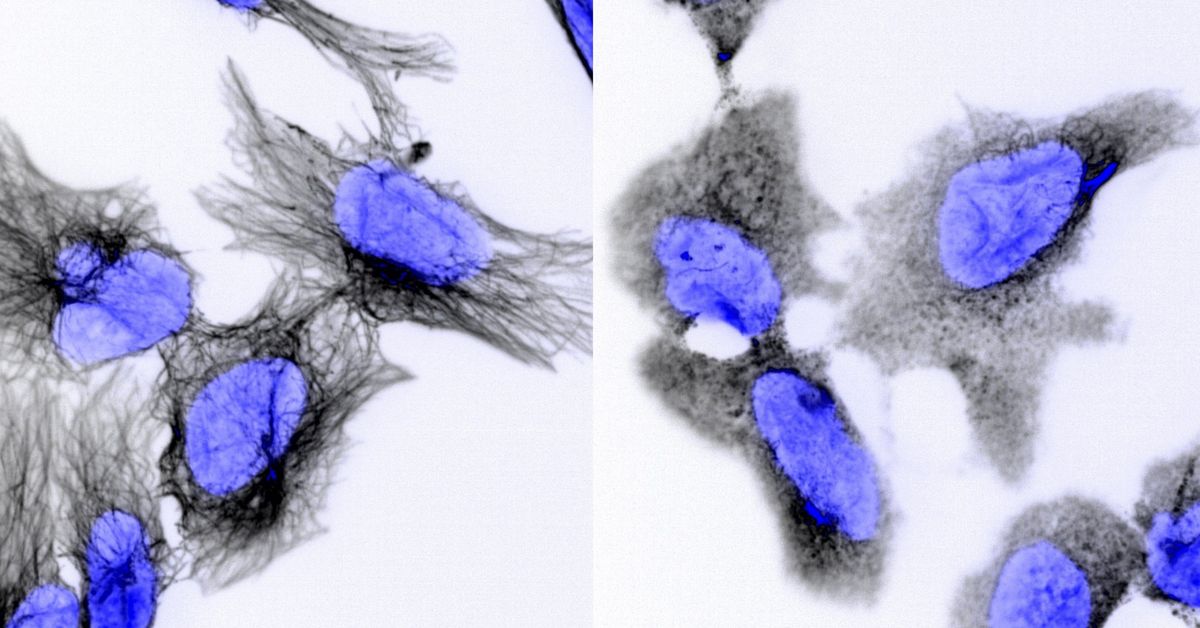 Neuroblastoma treatment could be found in new drug, according to research