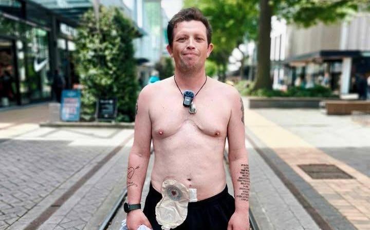 Taking steps to shake the shame after surgery