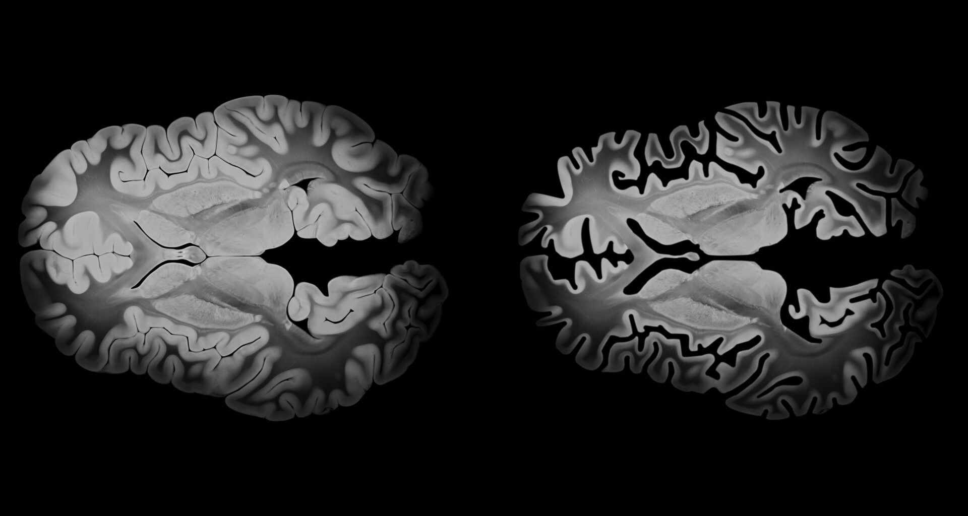 OTULIN enzyme found to control tau production in Alzheimer’s