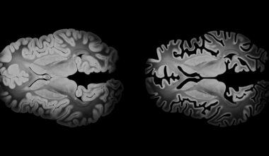 OTULIN enzyme found to control tau production in Alzheimer’s