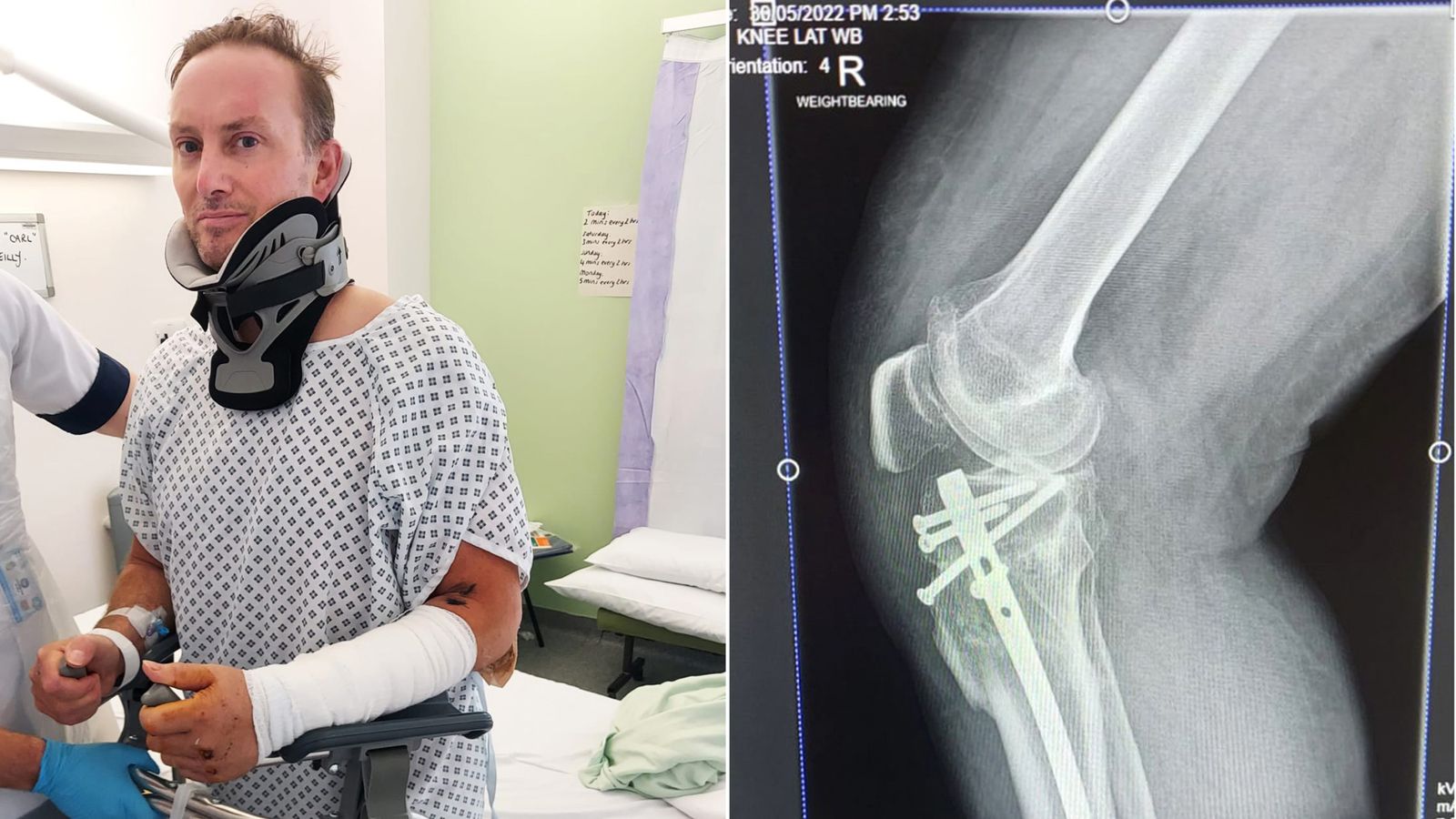 Cahal O'Reilly was hit by an uninsured driver and suffered serious injuries, with his leg requiring reconstructive surgery. Pic: MIB