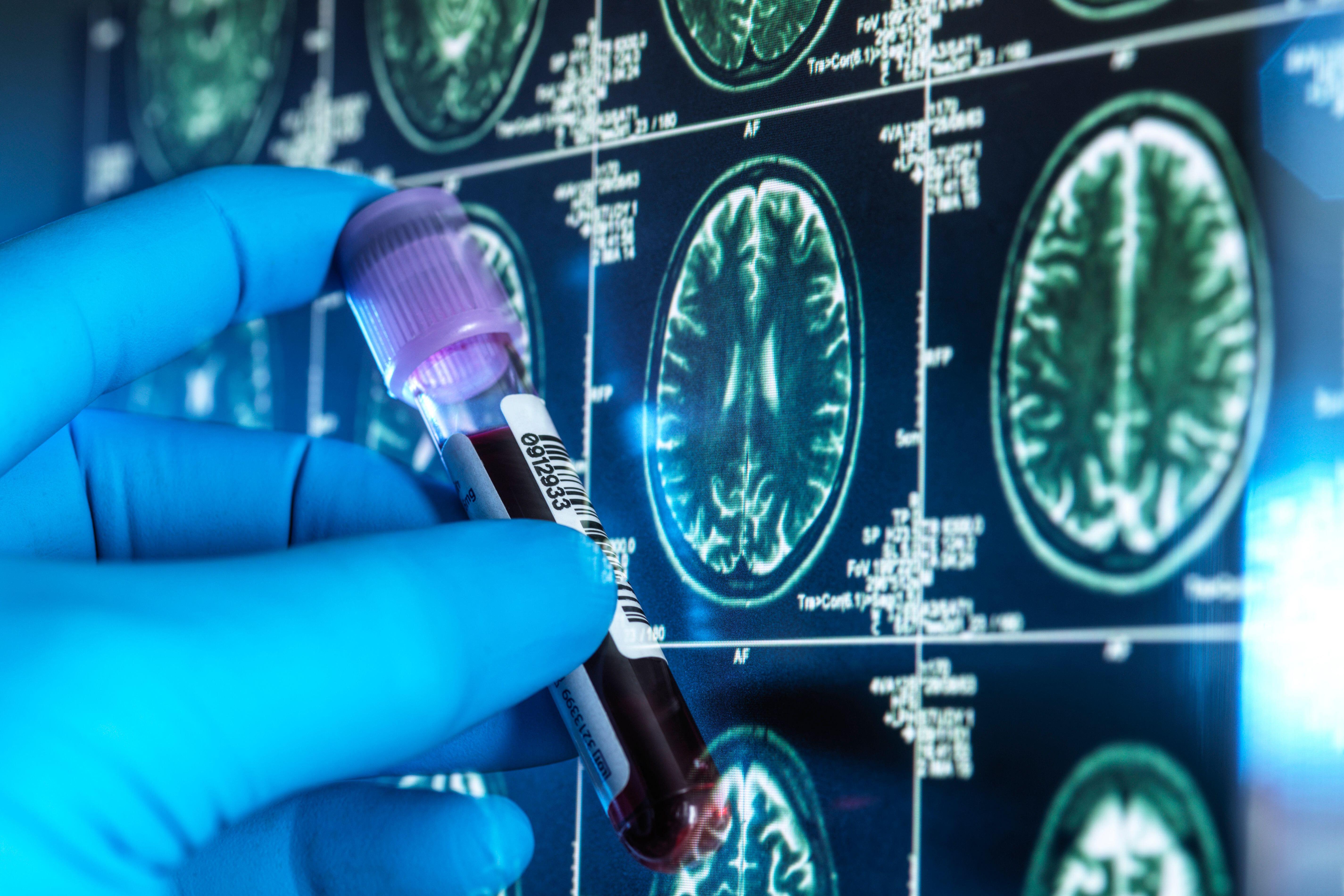Gloved hand holding a blood sample in front of brain scan images.