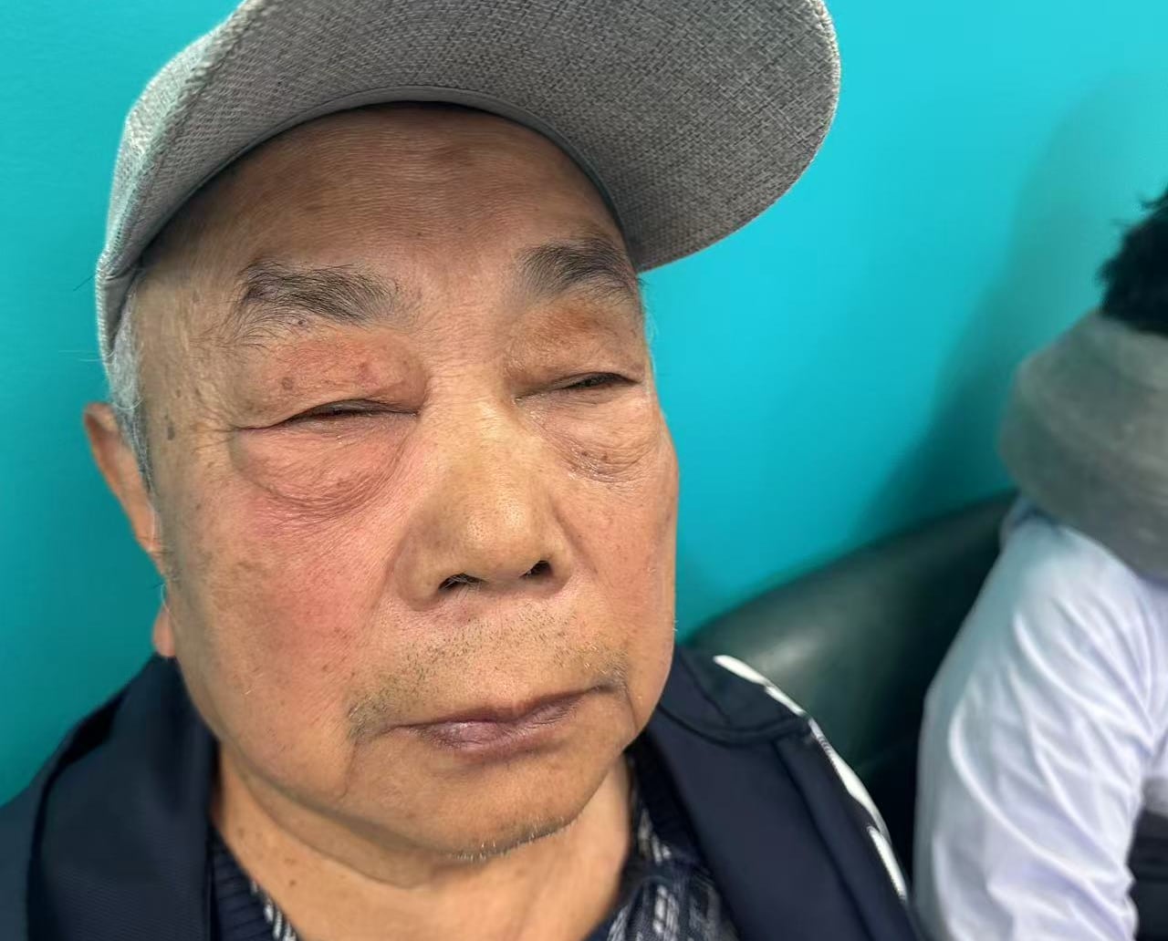 Elderly man sitting on a chair with a swollen eye
