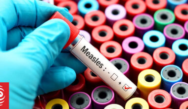 Paediatrician worries new measles wave spreading undetected