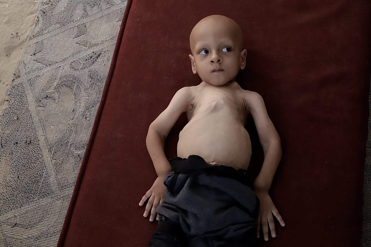 This photo taken on July 17, 2025, in Khan Younis, Gaza, shows Abdullah Abu Zarqa who was suffering from a condition causing poor growth, and brittle bones.  The following he was evacuated to Turkey for treatment, and passed away four days later. 