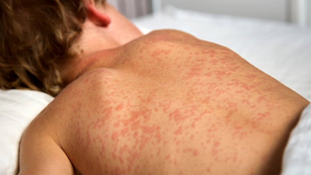 Christmas gathering, hardware store among Manitoba's latest measles exposure sites