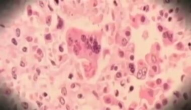 Newark Airport passenger may have exposed others to measles, New Jersey Health Department says