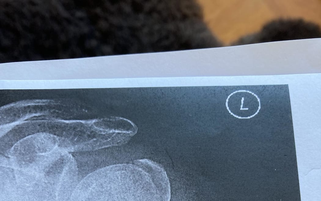 An x-ray of Selah Weingott's damaged shoulder.