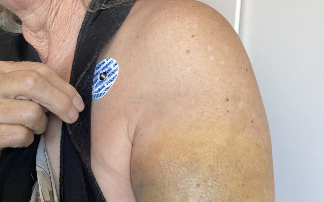 Bruising emerges after Selah Weingott was dumped on the deck of a fishing charter crossing the Pātea bar. She fractured her shoulder in two places and broke the humerus in her arm.
