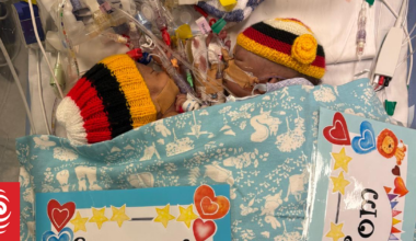 One of Papua New Guinea conjoined twins dies