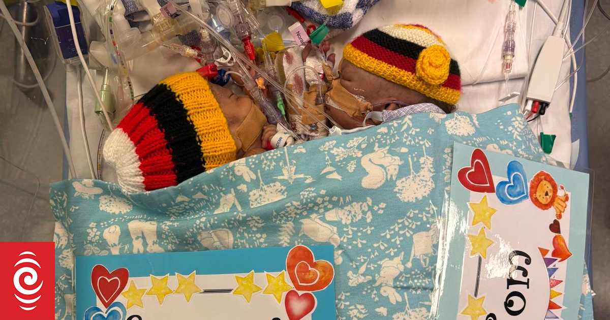 One of Papua New Guinea conjoined twins dies