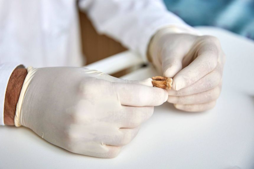 A tooth used for ancient DNA analyses during the study of Napoleon's army.