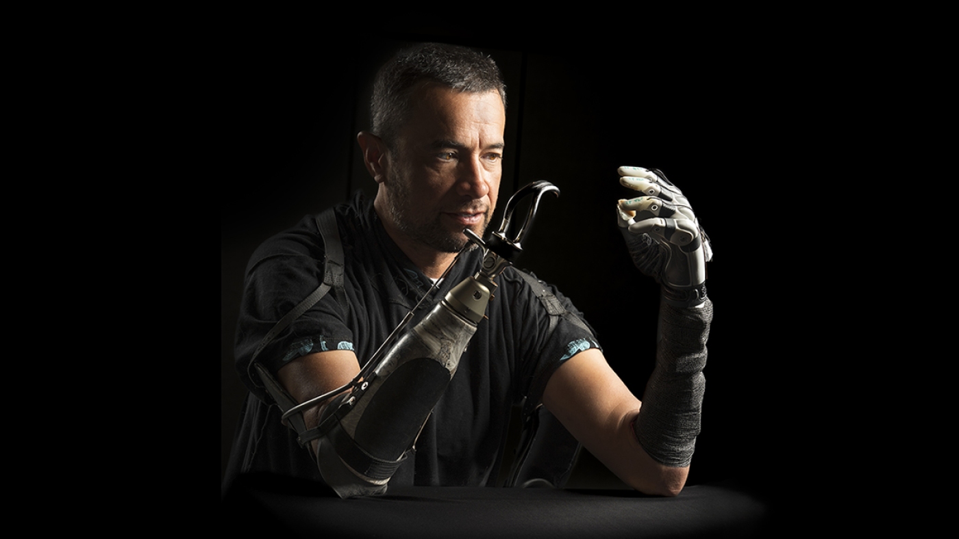 Amputees often feel disconnected from their bionic hands. AI could bridge the gap : Shots