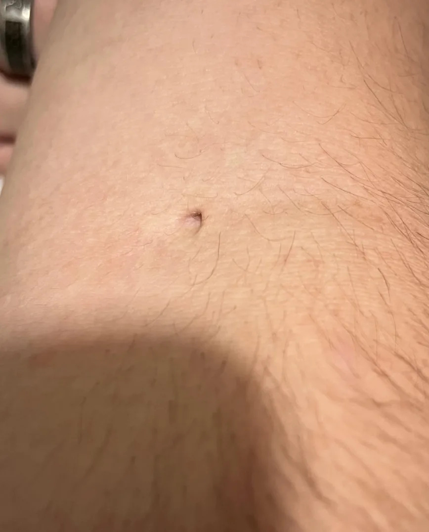 Close-up of a small scar or puncture mark on forearm skin, surrounded by light hair