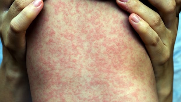 Morden church, rec centre latest measles exposure sites in Manitoba