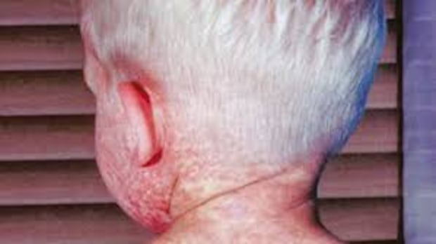 Alberta's measles case count topped 2,000 last year, and the outbreak is not over yet