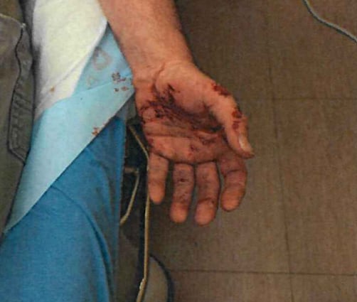 A photo shows a man's left hand with a number of cuts.