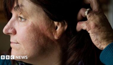 Gina Russo, a survivor of the 2003 fire at The Station nightclub, shows burn scars on the side of her face.