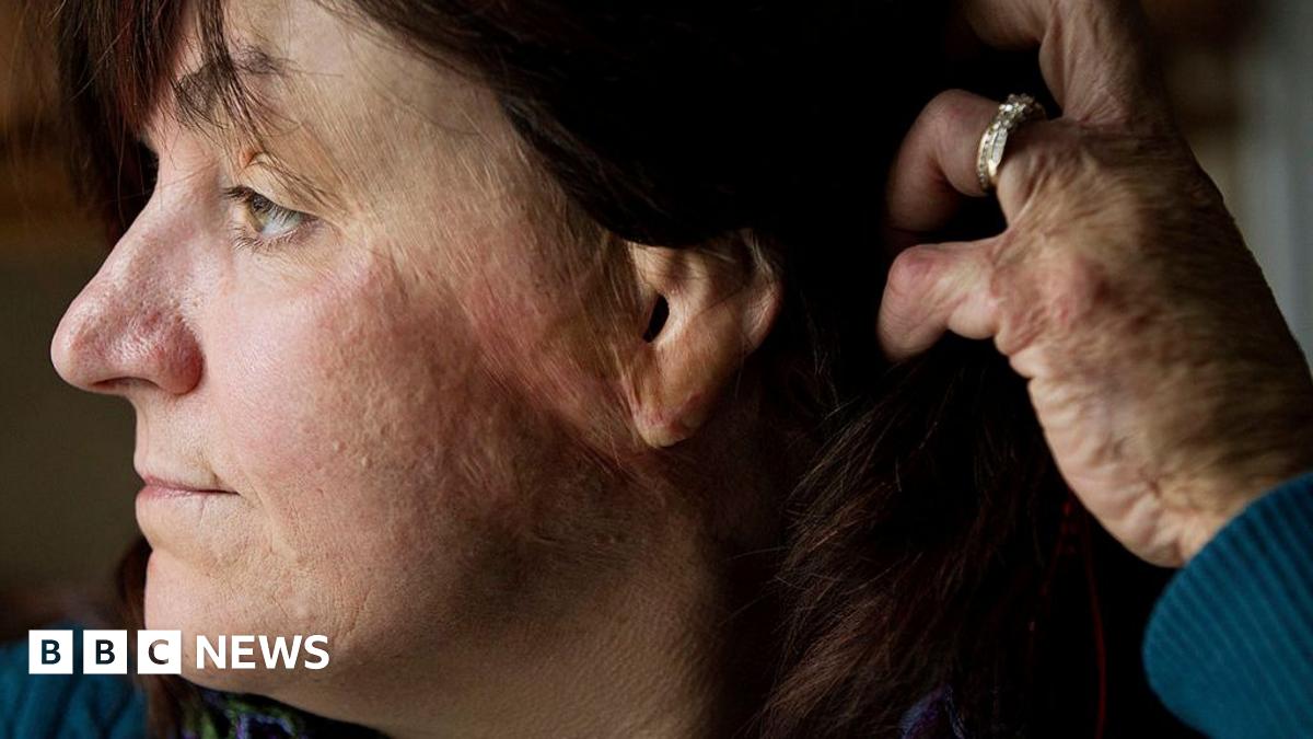 Gina Russo, a survivor of the 2003 fire at The Station nightclub, shows burn scars on the side of her face.