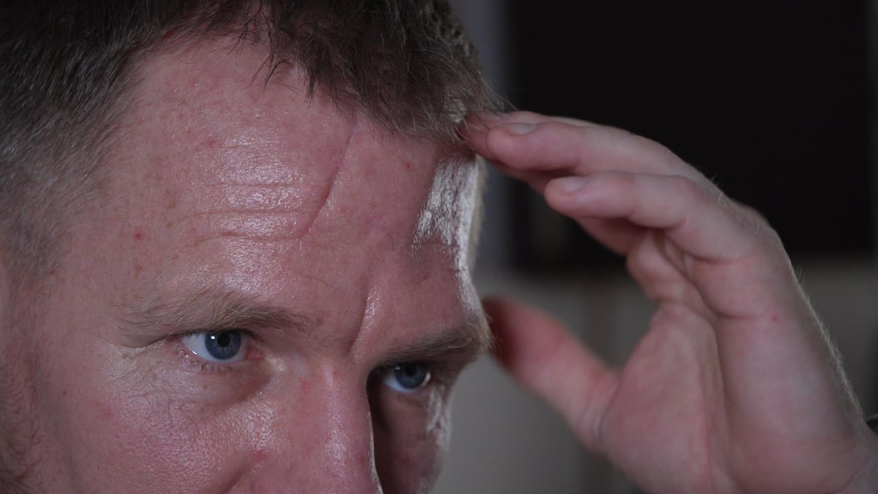 David Rauser, points to the section of his skull he is missing after being accidentally shot by an American fighting for Ukraine in November. 