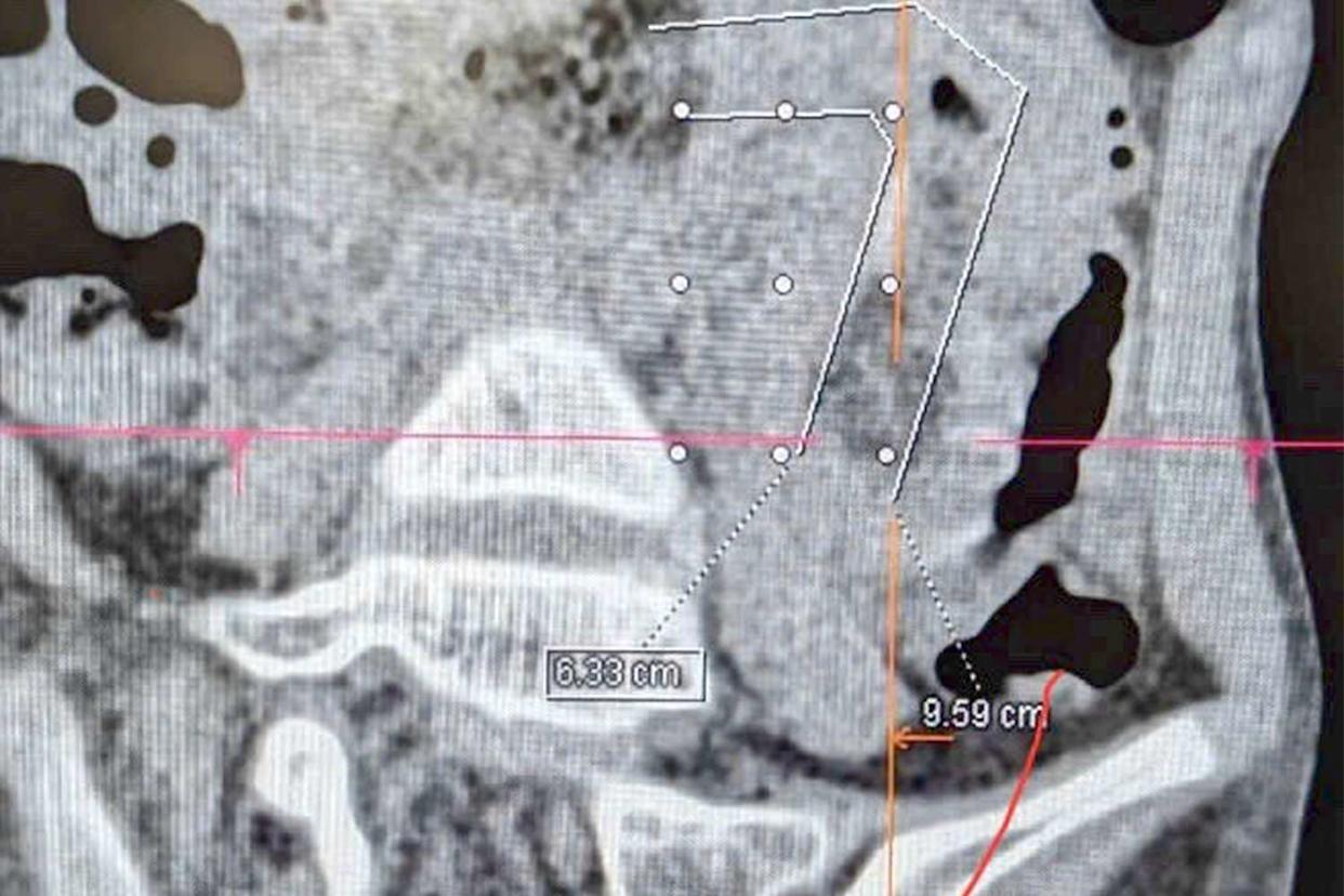 FV Hospital X-ray of H.'s stomach.