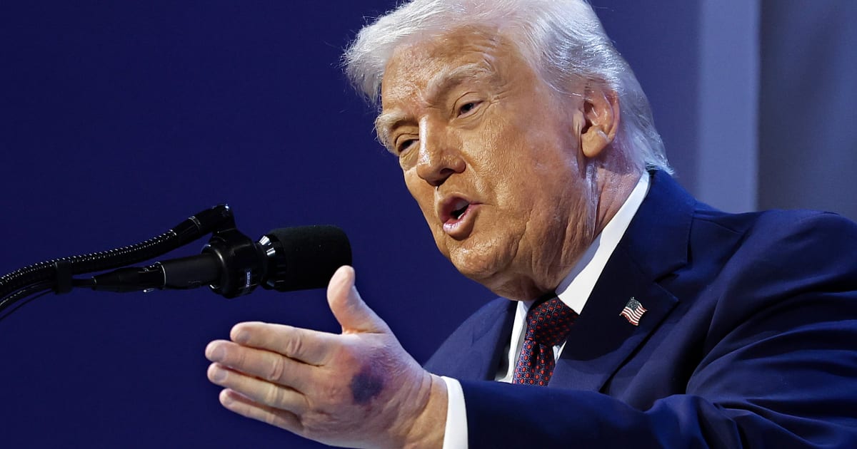 New photos show deep bruising on Trump’s hand at Davos