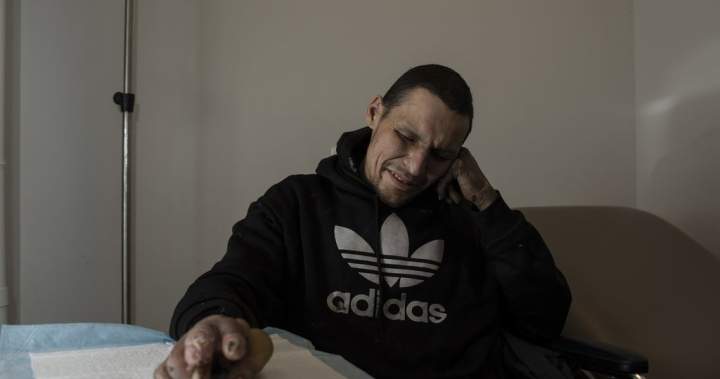 ‘Frostbite capital’: Efforts to reduce amputations underway in Edmonton