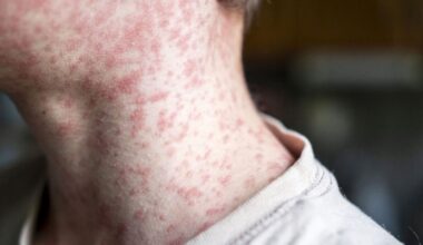 Measles MAPPED: Deadly disease takes hold across the UK - full list of hotspots