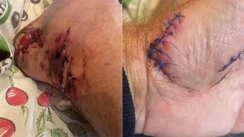Chris Murray A composite of two photos show stitches to a hand wound and to lacerations on his foot.