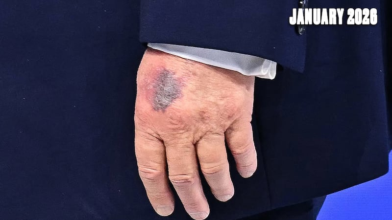 The bruises do not appear as much on Donald Trump's left hand as on his right.