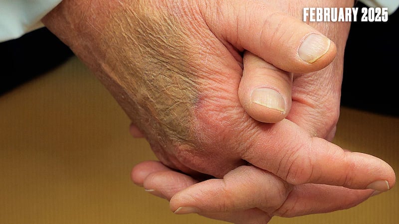 Donald Trump wore make-up to cover a large bruise on his hand during a February meeting with 47-year-old French President Emmanuel Macron.