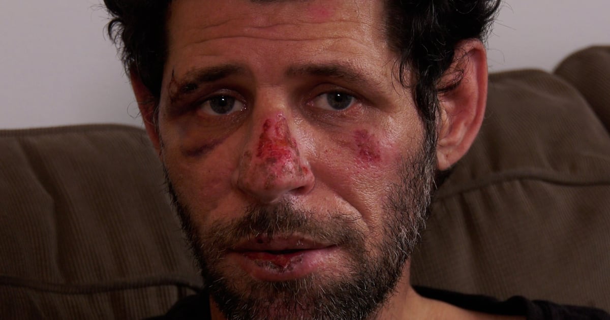 ‘I had a guardian angel over me’: Sarnia man recounts harrowing ordeal after being run over by car - CTV News