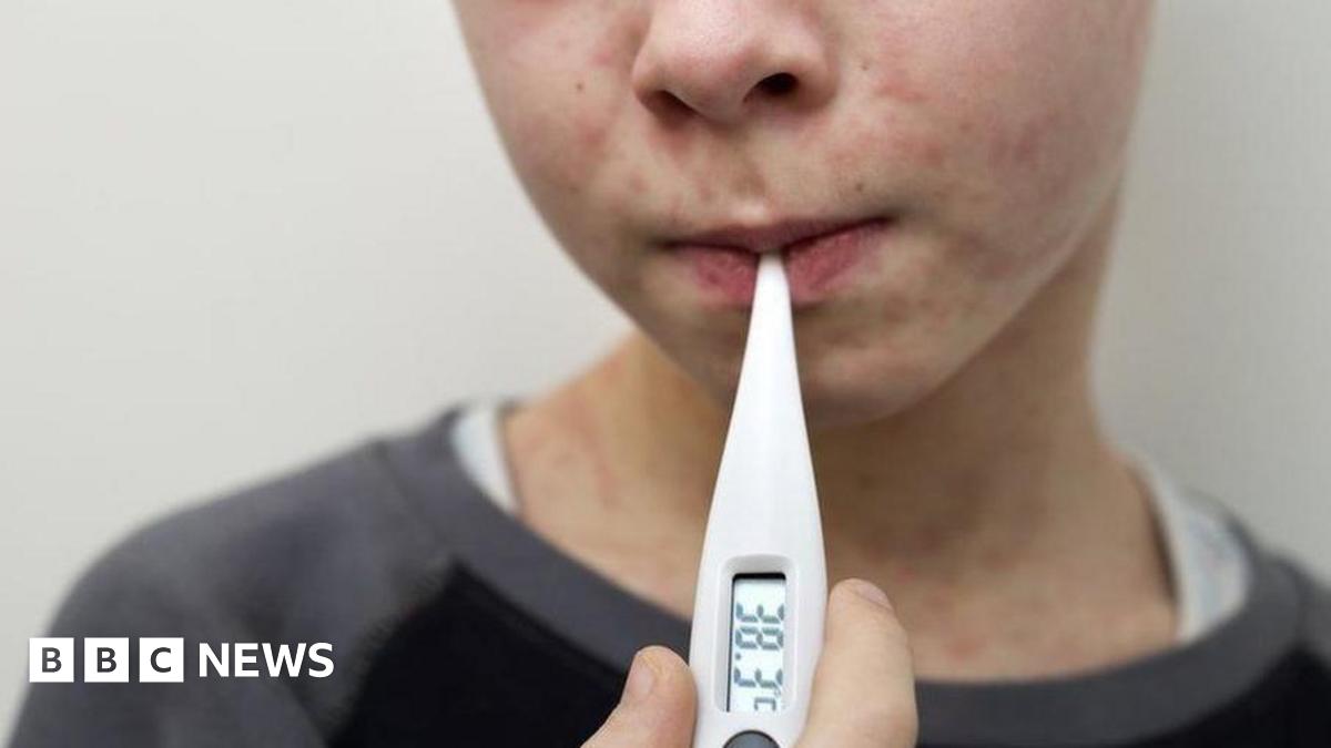 Boy with measles with thermometer in his mouth