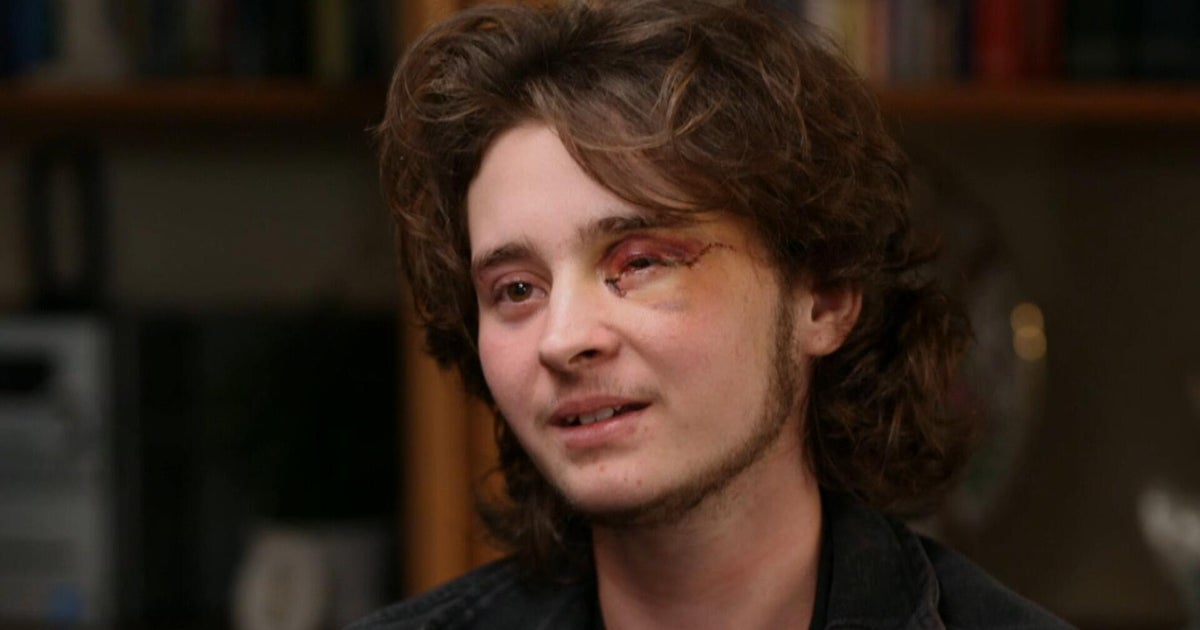 21-year-old says he's blind in left eye after federal agent shot him with less-lethal round at California protest