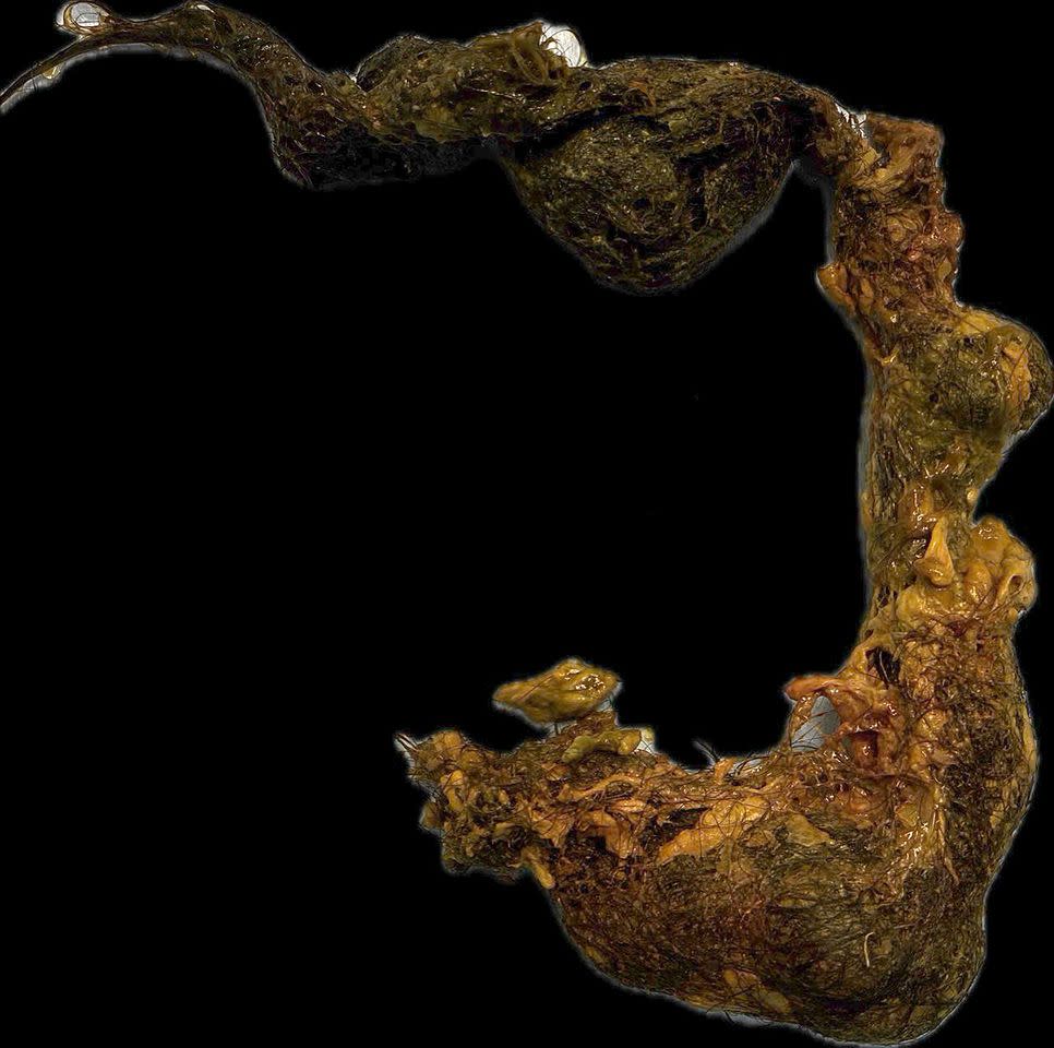 FV Hospital H.'s hairball.